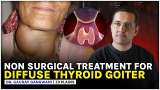 Non surgical treatment of diffuse thyroid goiter or hyperthyroidism  Dr Gaurav Gangwani [upl. by Erdnuaed]