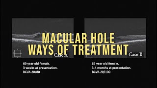 MACULAR HOLE [upl. by Kimball]