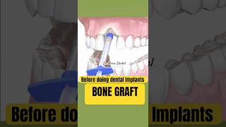 BONE GRAFT  Dental IMPLANTS [upl. by Fons]