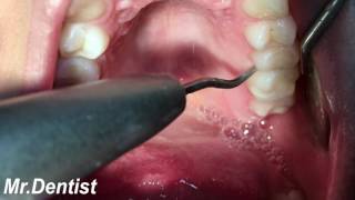 Treatment of periodontal disease [upl. by Alben]