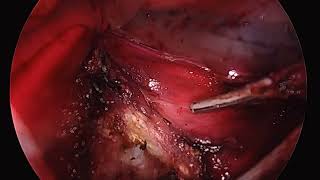 vNOTES Hysterectomy amp Adnexectomy [upl. by Borreri252]