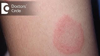 How to manage Chronic Ringworm infection  Dr Rajdeep Mysore [upl. by Drofnats]