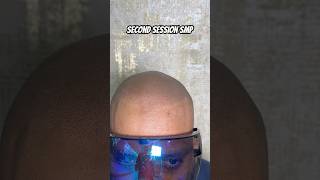 Second session scalp micropigmentation gives 50 results scalpmicropigmentationindia smp [upl. by Kuhn]