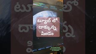 Ectopic pregnancy drkranthigynecologist పిండం గర్భసంచి లో కాకుండా ట్యూబ్ లో పెరిగింది [upl. by Irami830]