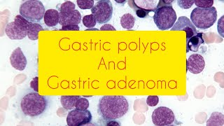 Gastric polyps and Gastric adenoma  GIT pathology  Easy explanation emotionalmedico [upl. by Haliek]