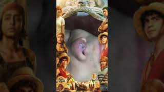 Blackheads Removal  Acne Treatment and Very Satisfying Satisfying Pimple pop blackheads [upl. by Farrow169]