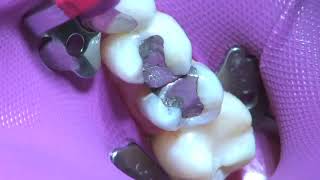 Palodent® Plus  Isolation of a Class II Restoration  Dentsply Sirona [upl. by Nibuz]