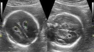 Anomaly scanBilateral choroid plexus cysts in fetusmedicalimagingradiology2828 [upl. by Colwen238]