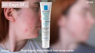 30 DAYS OF La RochePosay Effaclar Duo for Blemishes Blackheads amp PostAcne Marks One Month Review [upl. by Aleahpar]