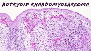 Botryoid embryonal rhabdomyosarcoma Basic soft tissue pathology quotsarcoma botryoidesquot usmle [upl. by Betthel153]