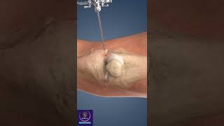 Knee Arthroscopy Procedure education shorts [upl. by Acinomed536]