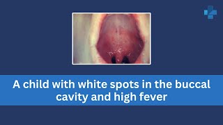 A child with white spots in the buccal cavity and high fever [upl. by Kilroy741]