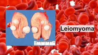 leiomyoma [upl. by Sunshine]