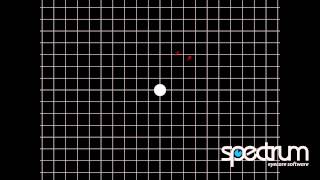 Clinical Tutorial  Foveal Grid [upl. by Timothy]