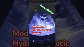 kidney scan hydronephrosis in kidney ultrasound usg kidney hydronephrosis [upl. by Faustina364]