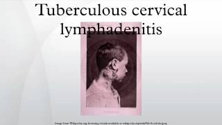 Tuberculous cervical lymphadenitis [upl. by Lidia]