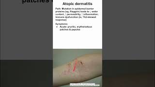 Atopic dermatitis eczema [upl. by Enihpad]