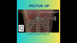 PECTUS UP DOTT PORRELLO [upl. by Iridis]