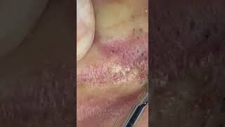 Super satisfied 😌 blackhead satisfying foryou fouryou fyp pimple [upl. by Anayi]